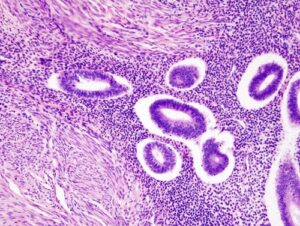 difference between a polyp and a cyst