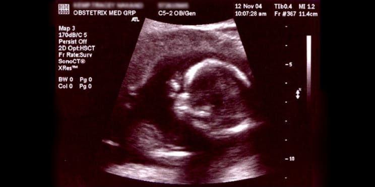 fetal first trimester testing