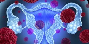 do I have uterine cancer, uterine cancer symptoms, uterine cancer diagnosis